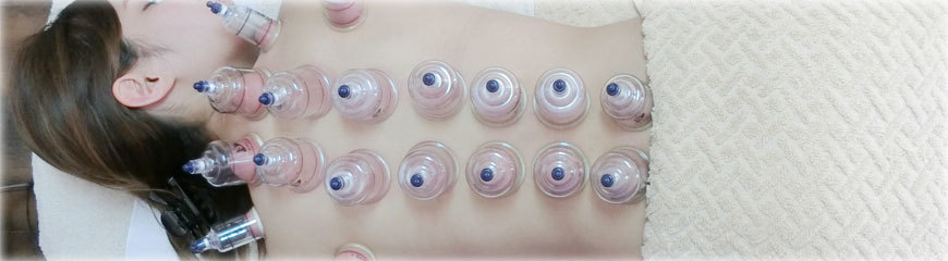 吸い玉（カッピング）の画像