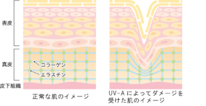 正常な肌とUV-Aによってダメージを受けた肌